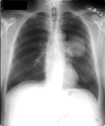Image:Lung_mass.jpg
