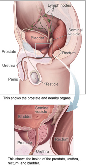 Image:Prostatelead.jpg