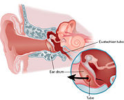 Ear Tube Placement and Location Source: Downloaded from http://www.healthatoz.com/healthatoz/Atoz/images/ency/00118495.jpg
